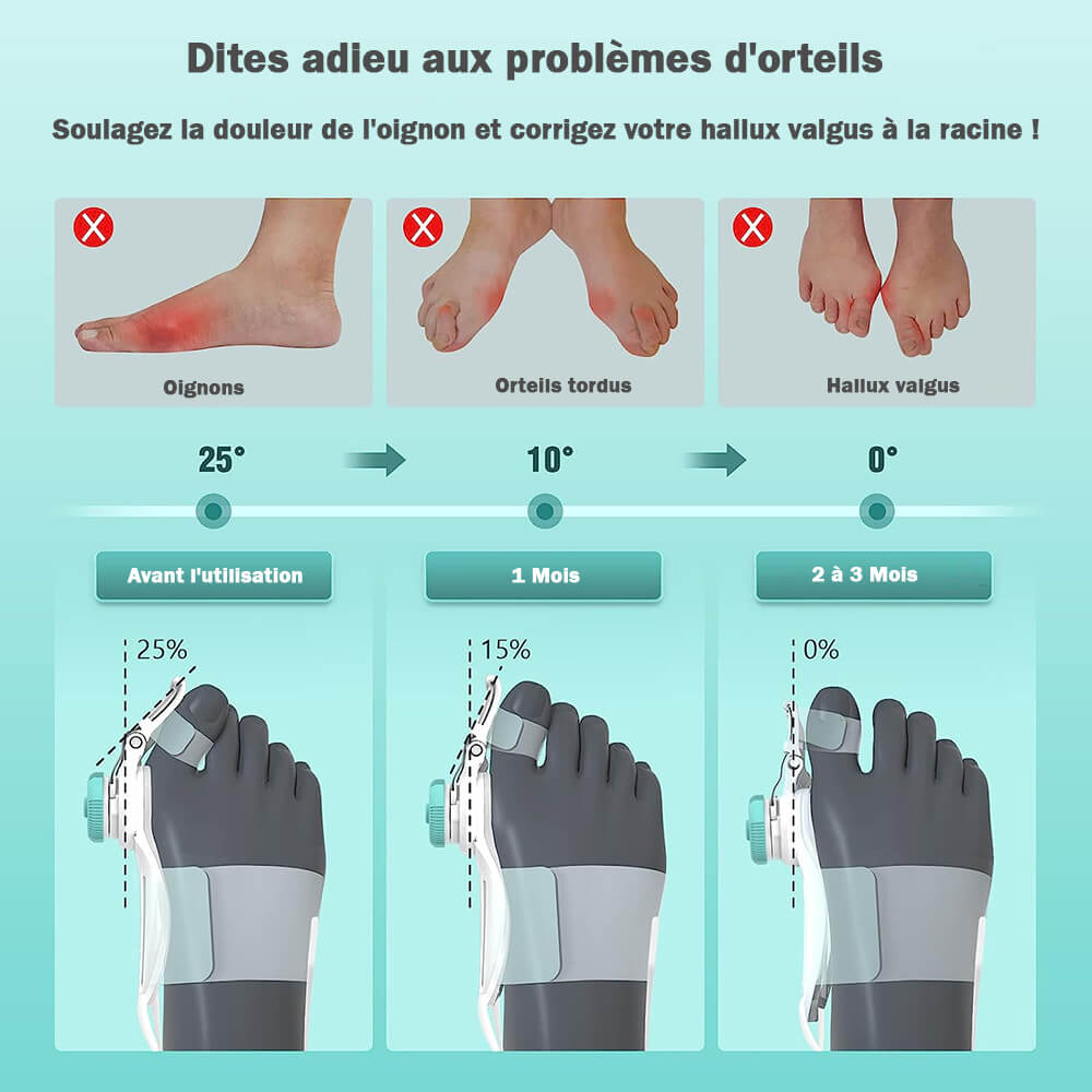 OignonFix™ -  Correcteur efficace pour l'hallux valgus